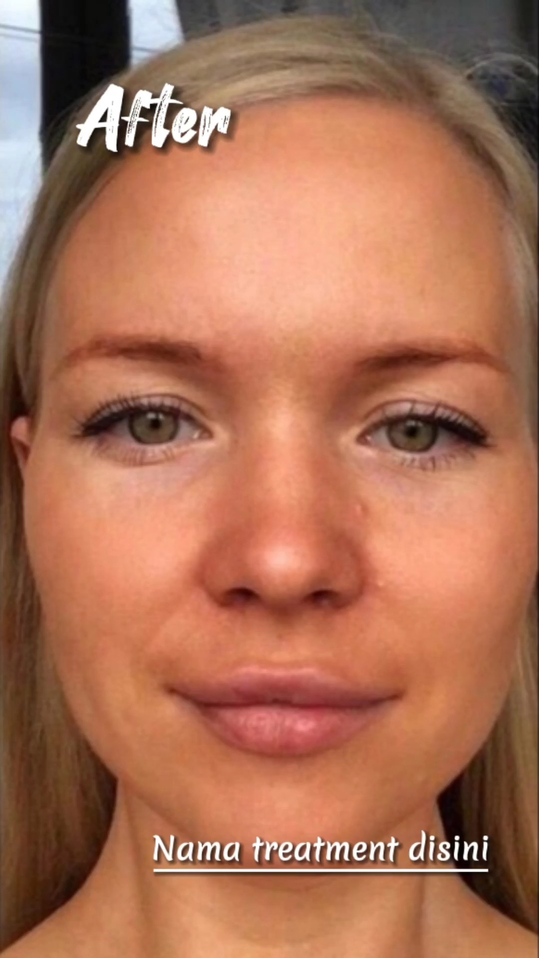 Facial antes depois