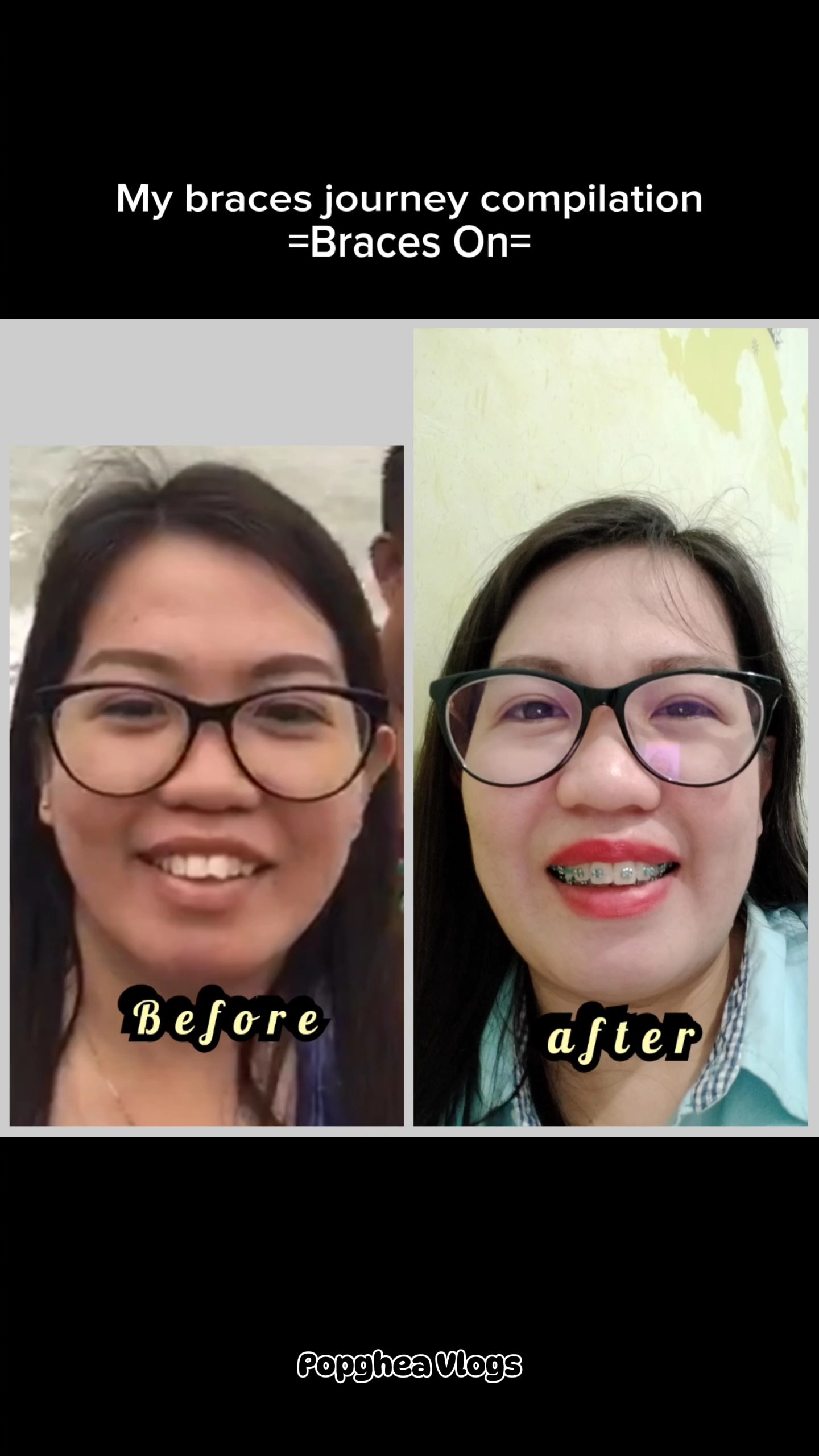 Braces Journey